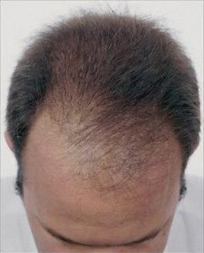 Do You Have Telogen Effluvium?